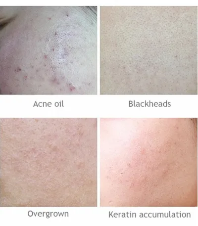 AICHUN BEAUTY Salicylic Acid Purifying Shrink Pores Exfoliation Anti-Acne Face Serum - 30ml